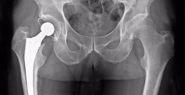 El IB Salut programa una charla para quien vaya a recibir una prótesis